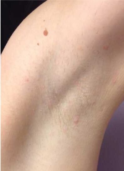 Laser-Hair-Removal-best doctor