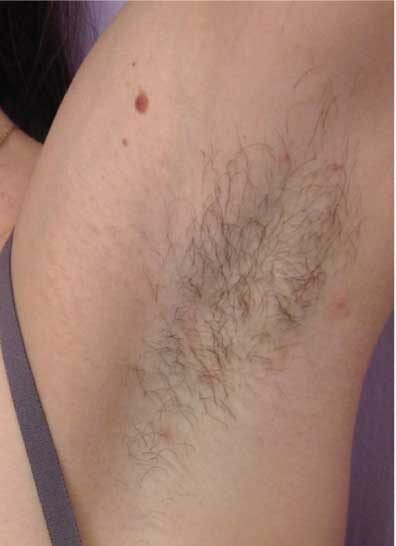 Laser-Hair-Removal-woodstock skin clinic