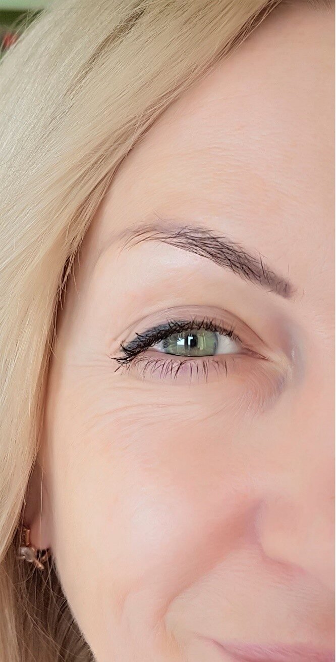 before-and-after-anit-wrinkle-woodstock-clinic