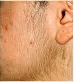 IPL Laser Hair Removal men woodstock